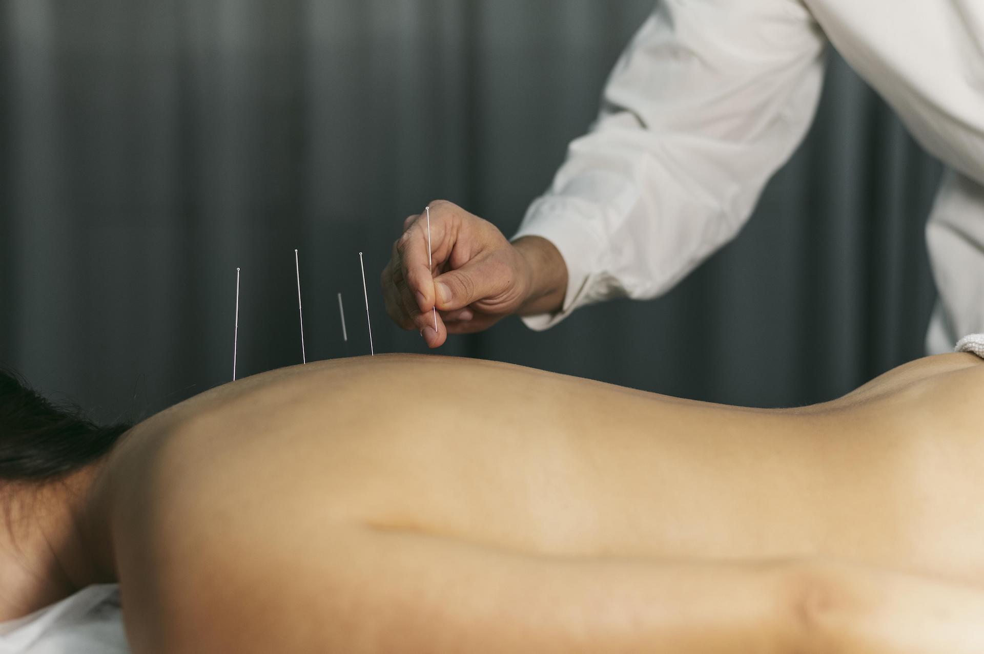 Acupuncture process